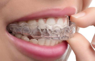 Чим елайнери краще ніж брекети?
