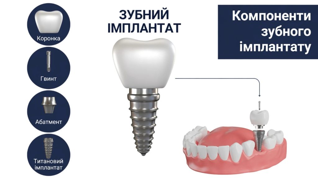 що потрібно для імплантації зубів